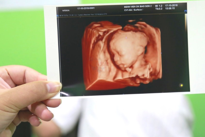 Siêu âm hình thái học 4D